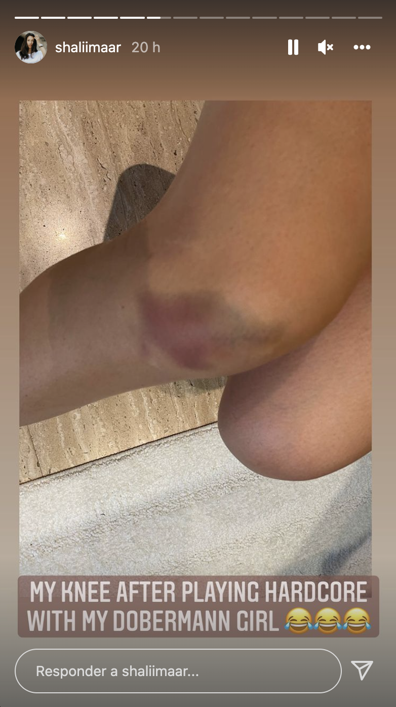 La mujer de David Alaba se destroza la rodilla jugando con su doberman: duele verlo