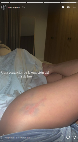 Sandra Garal muestra la lesión tras el partido ante el City